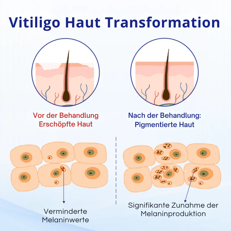 Cvreoz® Spray zur Behandlung von Vitiligo