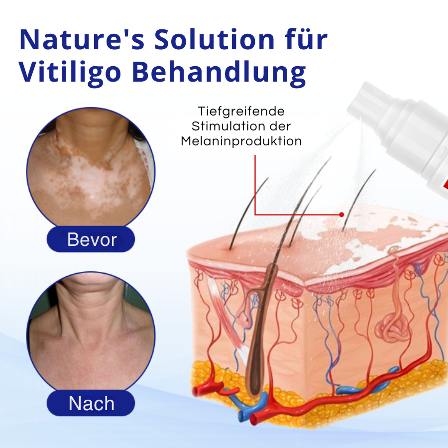 Cvreoz® Spray zur Behandlung von Vitiligo