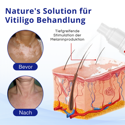 Cvreoz® Spray zur Behandlung von Vitiligo