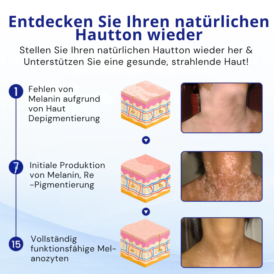 Cvreoz® Spray zur Behandlung von Vitiligo