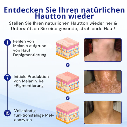Cvreoz® Spray zur Behandlung von Vitiligo